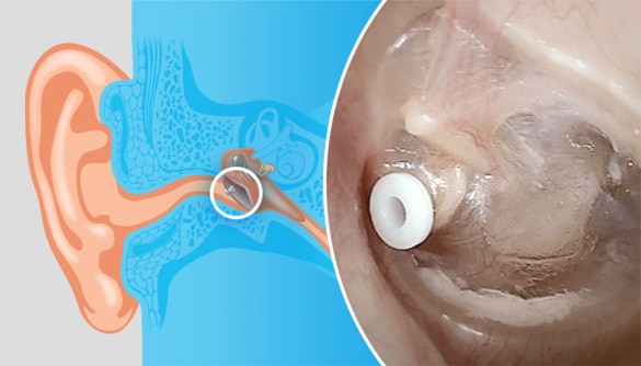 ear tubes
