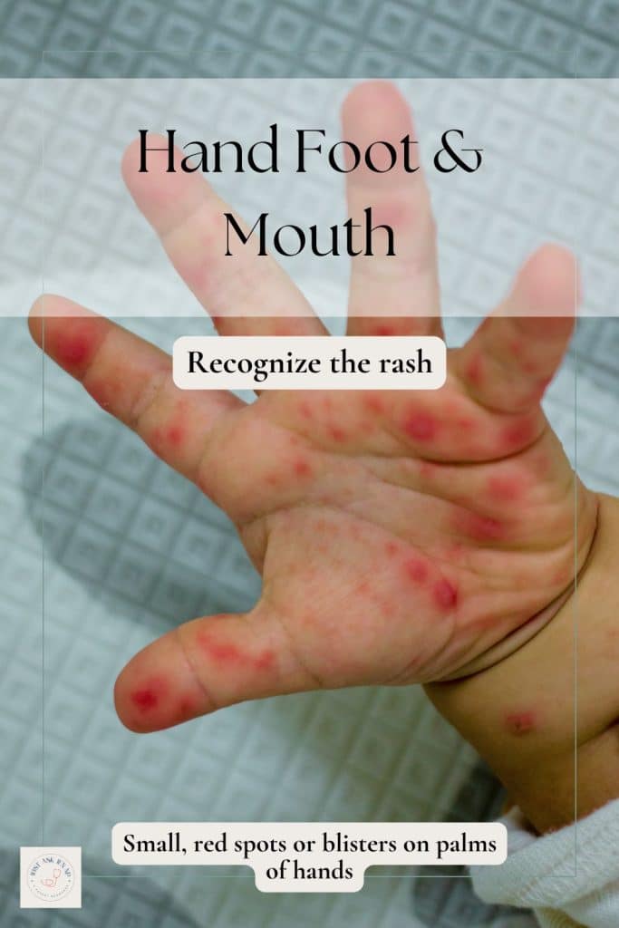 hand foot and mouth