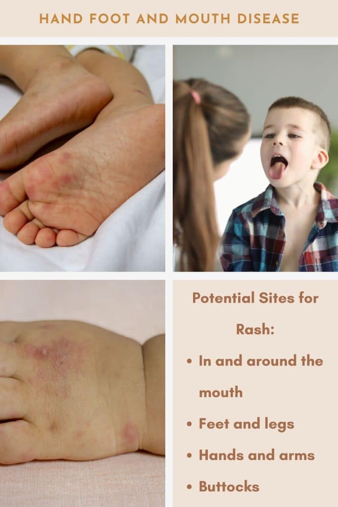 hand foot and mouth disease