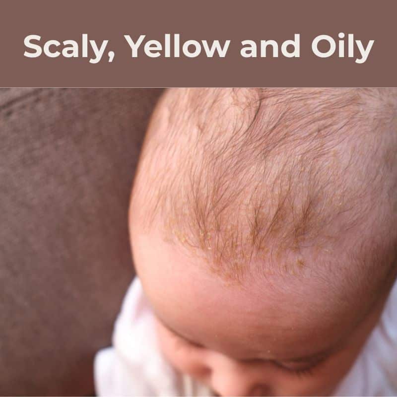 cradle cap